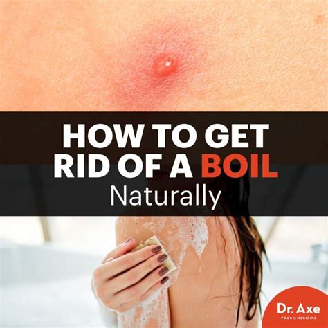 How to Get Rid of a Boil .